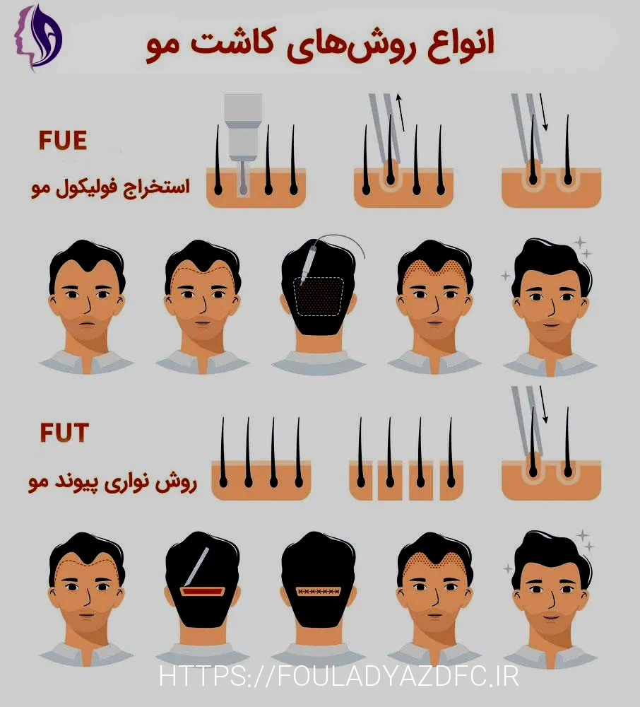 کاشت مو تهران