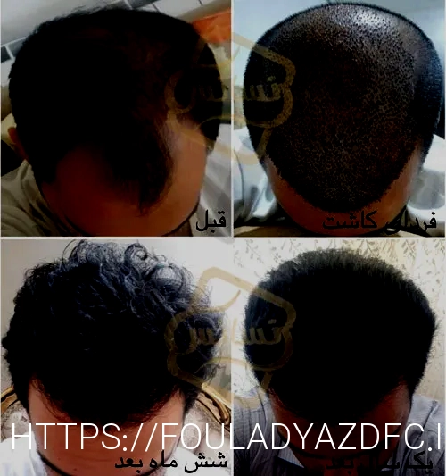 کاشت مو تهران