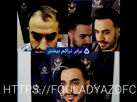 کاشت مو تهران